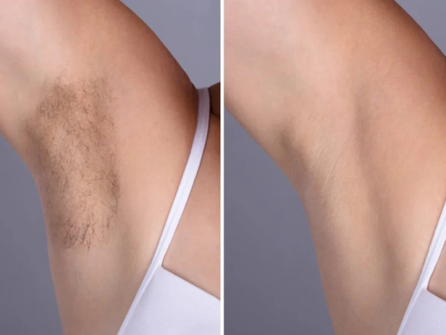 Laser hair removal Treatment in Dubai: The Rise of Pain-Free Laser Technologies