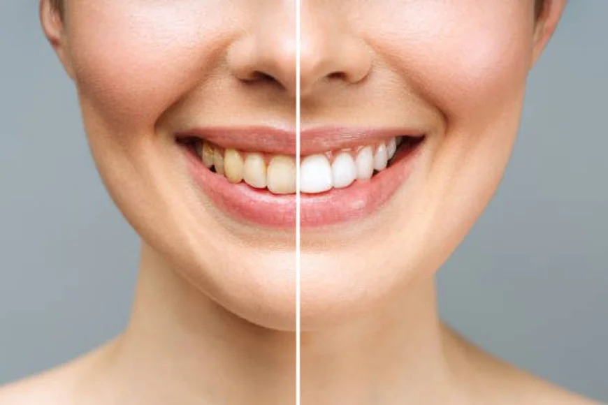 What Are the Latest Innovations in Teeth Whitening?