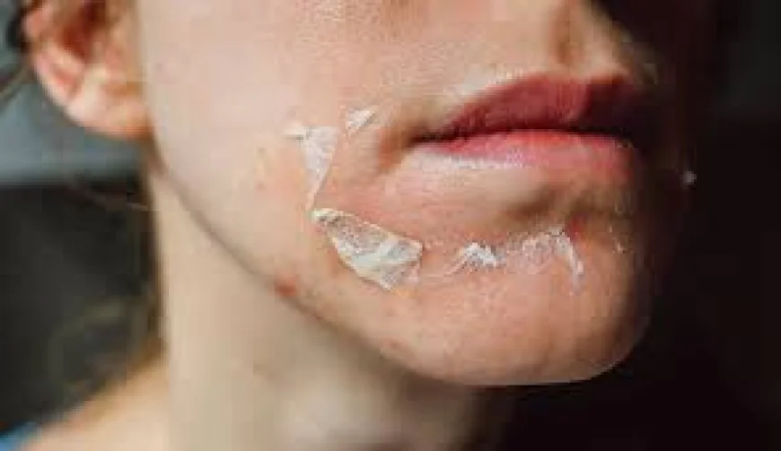 Can Chemical Peeling Help With Wrinkles?