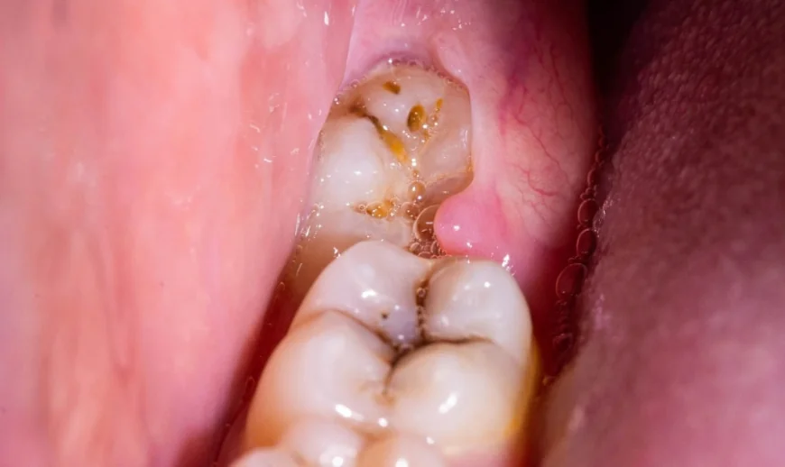 How Long Should You Rest After Wisdom Tooth Surgery?