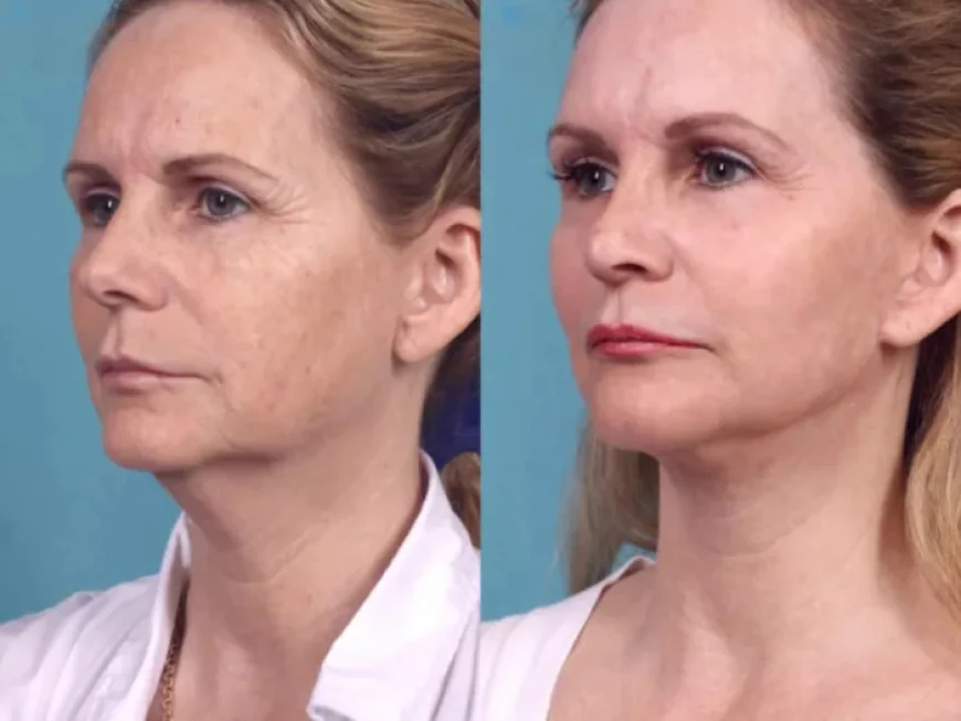 Chemical Peel Benefits for Modern Lifestyles by Best Plastic Surgeons in dubai