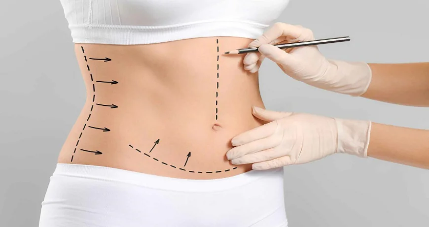 Tumescent Liposuction – A Safer Option in Islamabad?