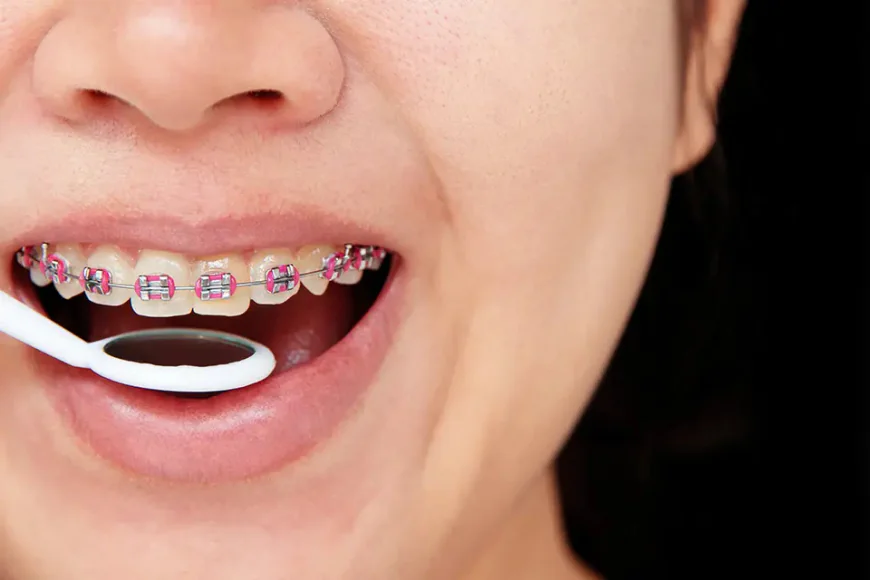 Can You Eat Popcorn with Metal Braces?