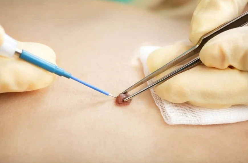 What’s the Average Skin Wart Removal Cost in Dubai?