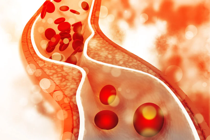 How Diet Impacts High Cholesterolemia in Dubai Residents