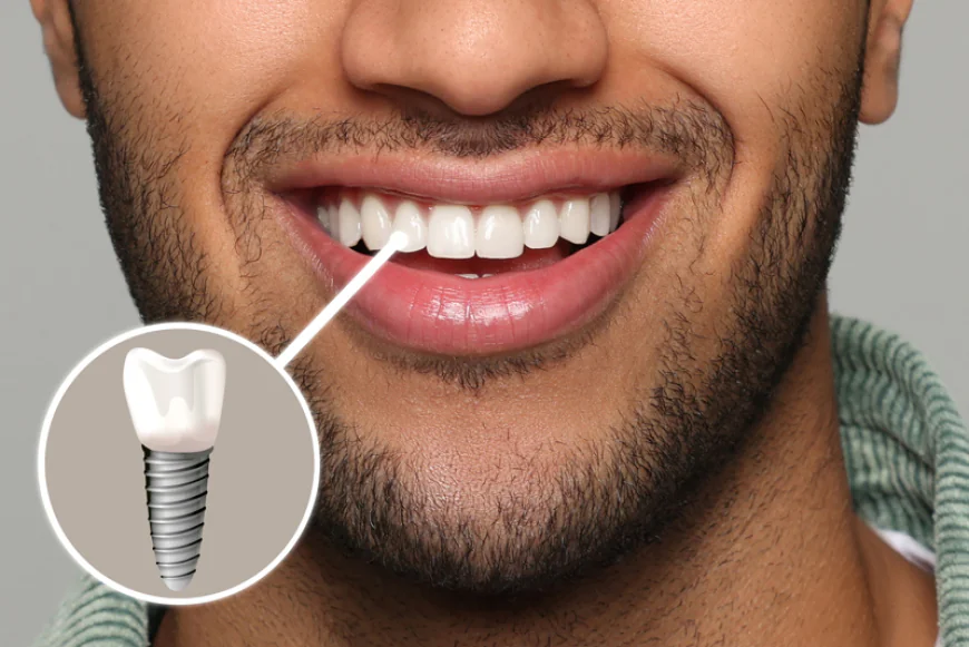 How to Make Dental Implants Last a Lifetime?