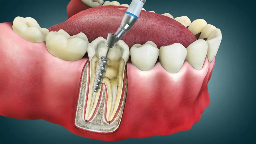 Top Clinics Offering Painless Root Canal Treatment in Delhi