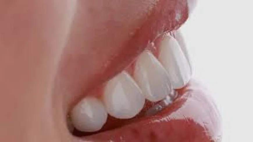What Problems Can Composite Veneers Fix?