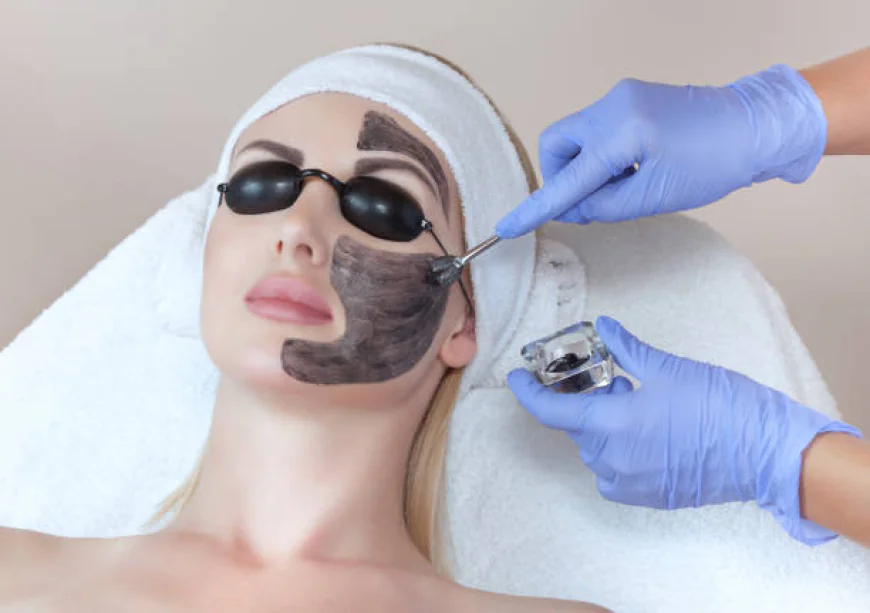 Laser Carbon Peel in Islamabad: Everything You Need to Know