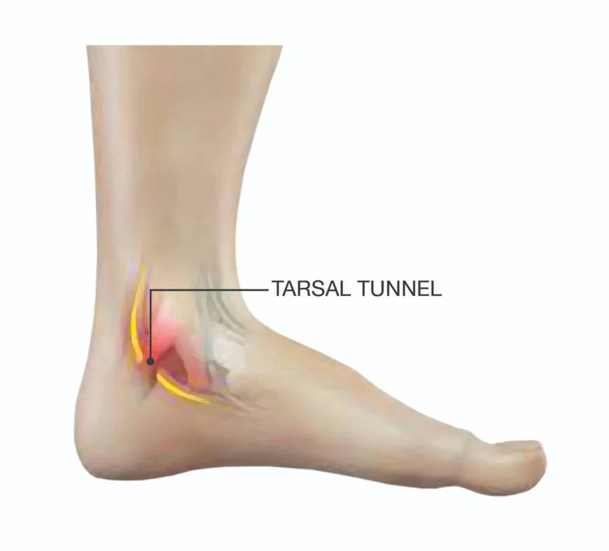 Managing Tarsal Tunnel Syndrome Symptoms Effectively