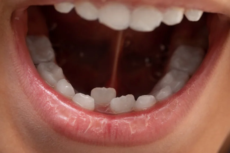 Can Overlapping Teeth Be Fixed in One Visit?
