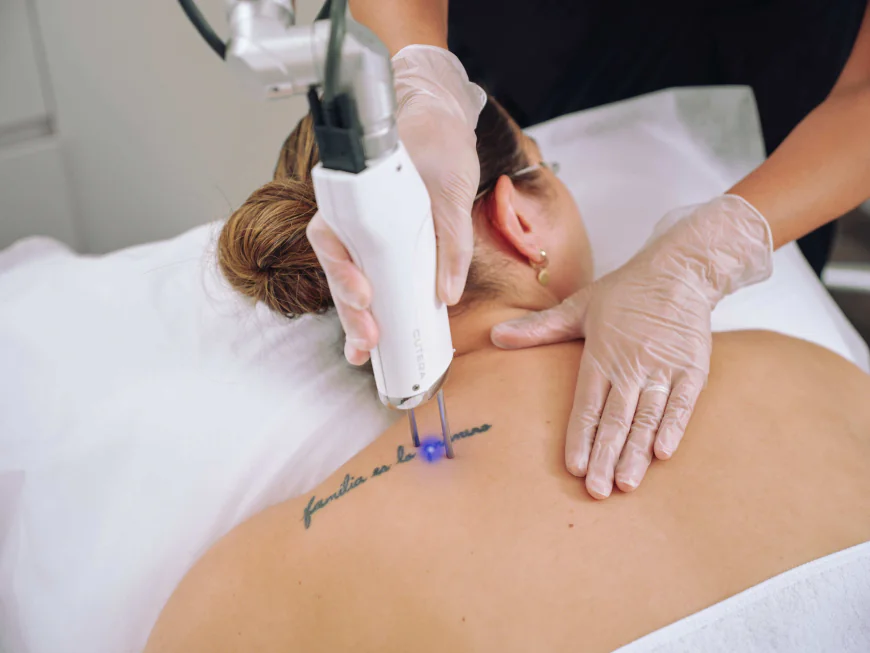 How Can Laser Tattoo Removal Boost Confidence and Skin Appearance?