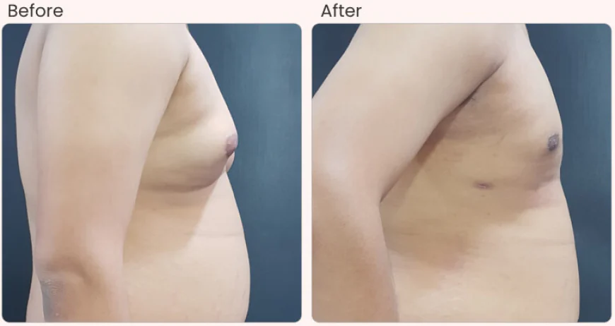 Gynecomastia Treatment in Delhi - Dr Rajat Gupta