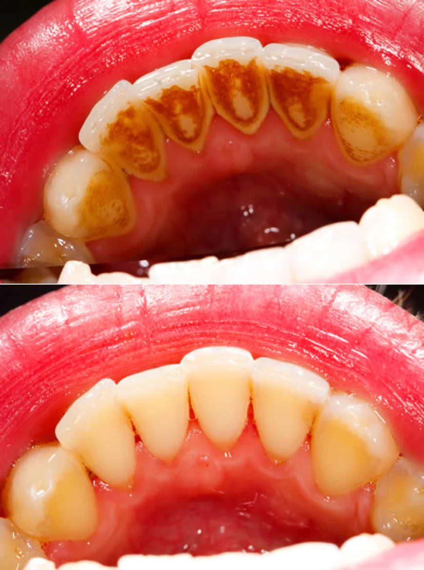 Can I Get Stain Removal If I Have Braces or Aligners?