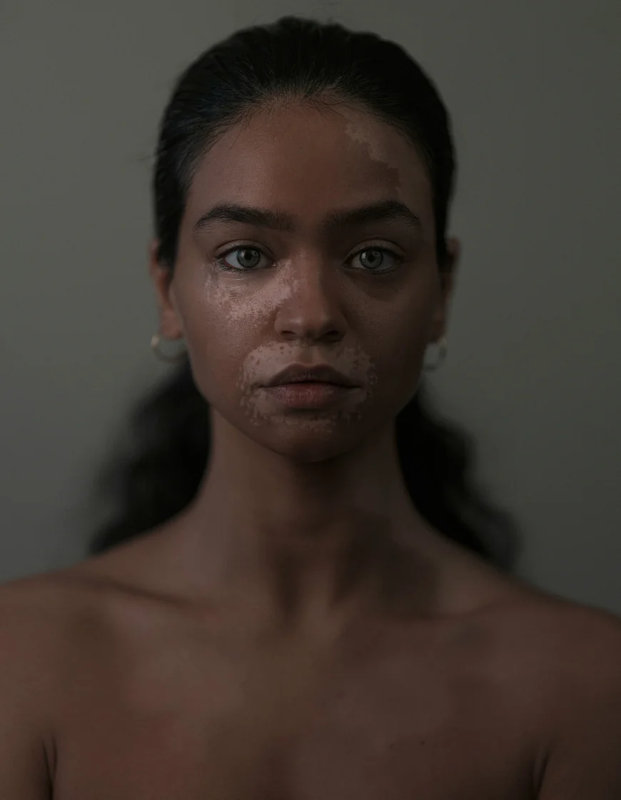 More Than a Rash: Uncovering the Hidden Challenges of Living with Cutaneous Lupus 