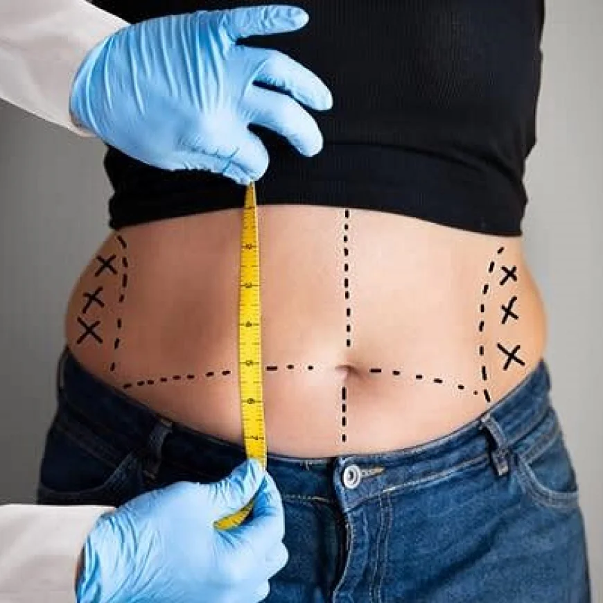 Abdominoplasty After Pregnancy: Restore, Tighten, and Tone
