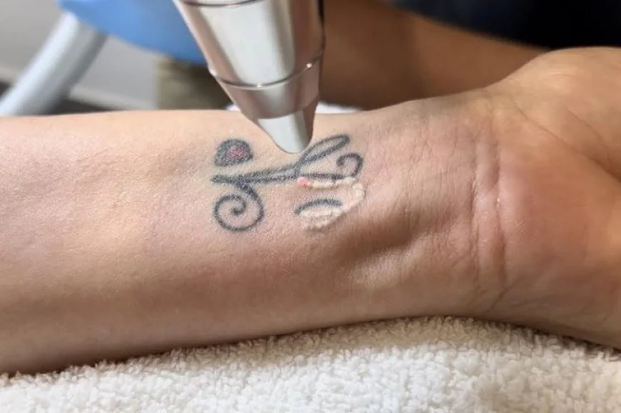 Laser Tattoo Removal vs. Other Tattoo Removal Methods: Pros and Cons