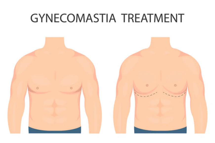 Permanent Solutions for Gynecomastia in Islamabad