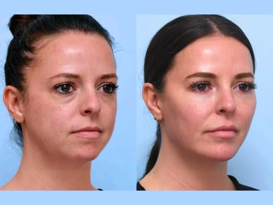 Thread Lift Treatment in Dubai: Non-Surgical Skin Rejuvenation for a Youthful Glow