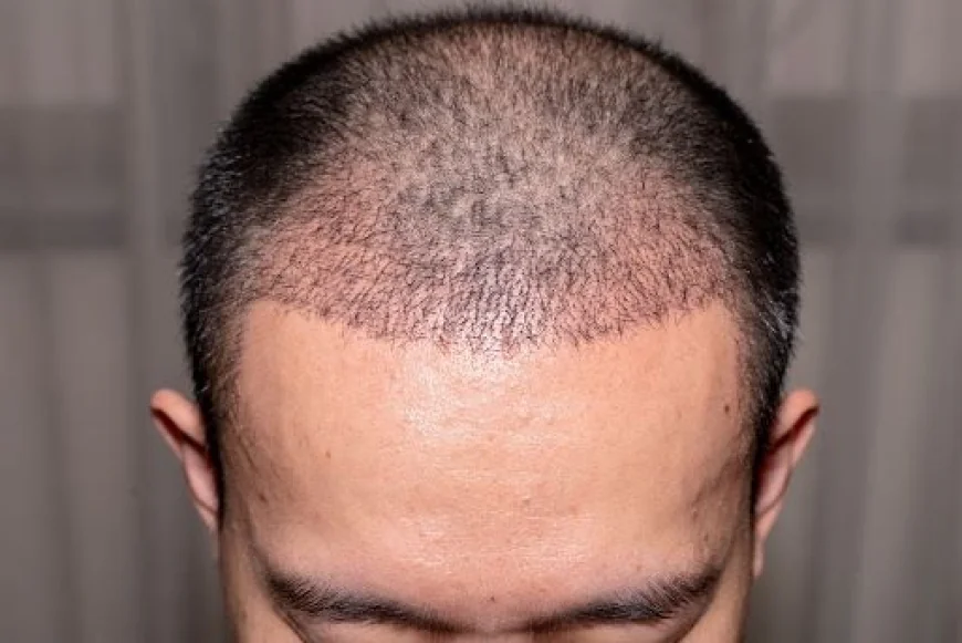 Hair Transplantation in Dubai: Techniques You Should Know