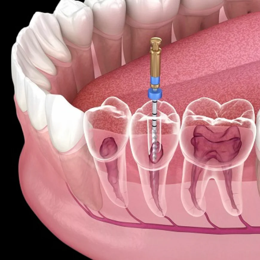 Root Canal Explained: Step-by-Step Procedure