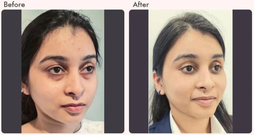 Eyelid surgery cost in Delhi - Dr Rajat Gupta