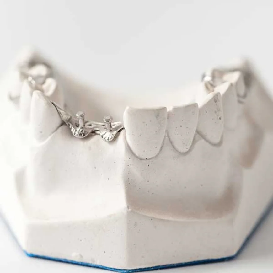 What Are the Benefits of Getting Dental Implants in Houston?