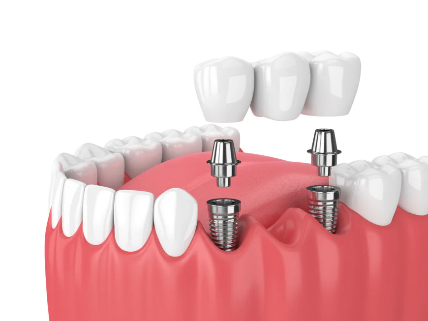 Top Rated Same-Day Implant Dentists Near Me