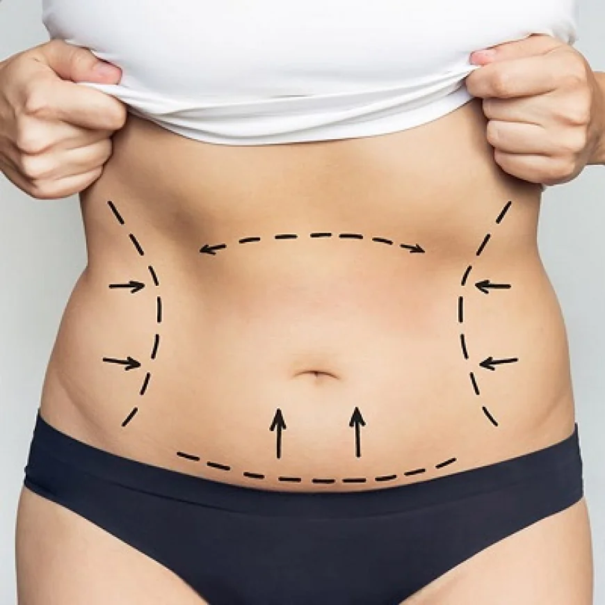 Liposuction Financing Options: Making Surgery Affordable