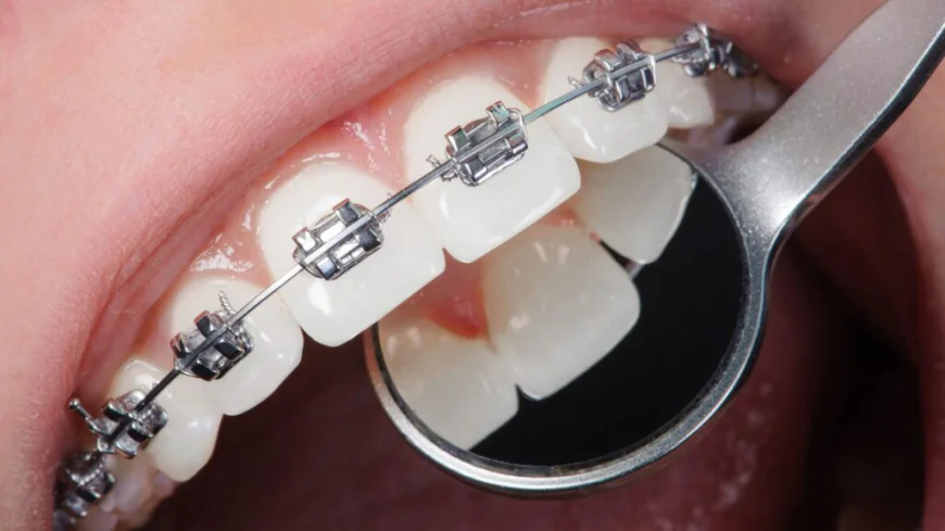 Do Braces Move Your Teeth Permanently?