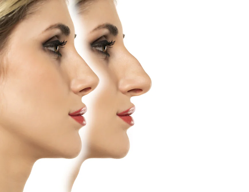 Learn About Modern Techniques Used in Rhinoplasty Surgery in Dubai
