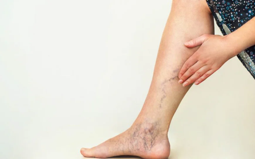 Best Non-Invasive Methods for Spider Vein Removal in Islamabad