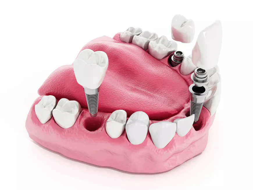 Everything You Need to Know About Dental Implants in Islamabad
