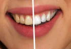 Smile Makeover on a Budget: How to Save on Veneers for Teeth Prices