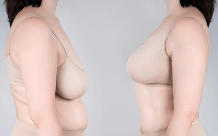 Ideal Candidates for RG Flap Breast Reduction: Who Benefits Most