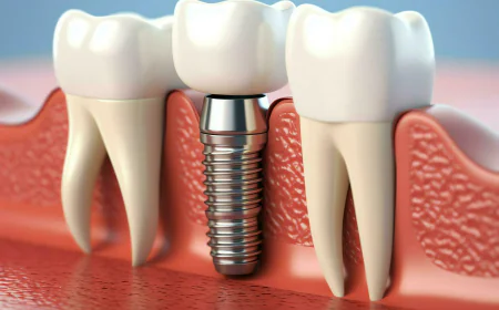 Perfect Smile Restoration: Trusted Dental Implants Clinic in Islamabad F7