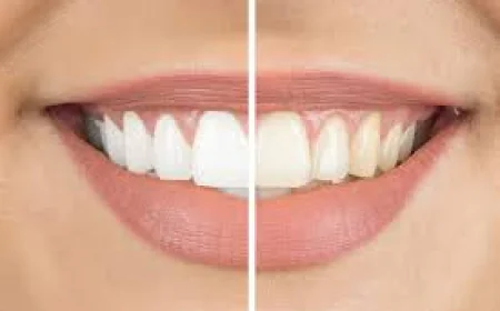 How Do Dentists Whiten Teeth Professionally?