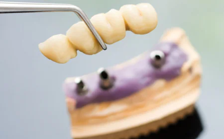 How to Find the Best Dentist for Dental Implants in Montrose?