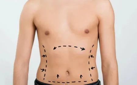 Liposuction Surgery in Dubai: Achieving Safe Body Contouring