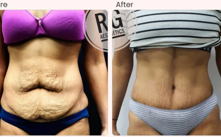 Tummy Tuck Surgery cost in Delhi - Dr Rajat Gupta