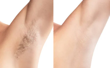 Laser Hair Removal Results in Riyadh