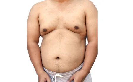 What’s the Difference Between Gynecomastia and Chest Fat?