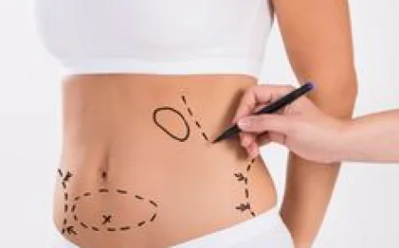 Liposuction in Riyadh: Addressing Common Myths and Facts
