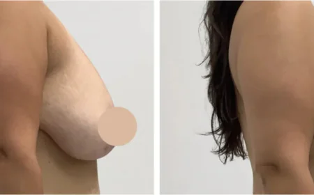 Redefine Your Shape with a Breast Lift in Dubai Performed by the Best Doctors in Dubai