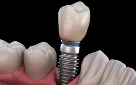 Why Jawbone Density Matters for Successful Complete Mouth Implants