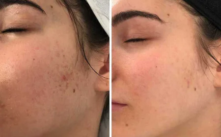 Professional Microneedling for Acne Scars in Islamabad