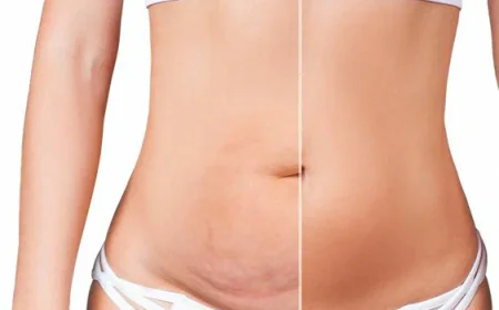 Transform Your Body with Safe and Effective Liposuction in Islamabad