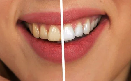 Smile Makeover on a Budget: How to Save on Veneers for Teeth Prices