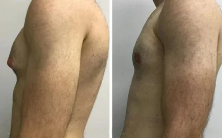 Best Gynecomastia Doctors in Dubai Combining Art and Surgical Skill