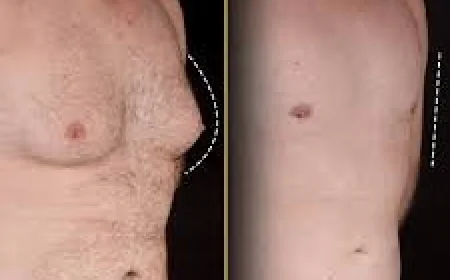 Insurance and Gynecomastia in Dubai: What’s Covered and What’s Not